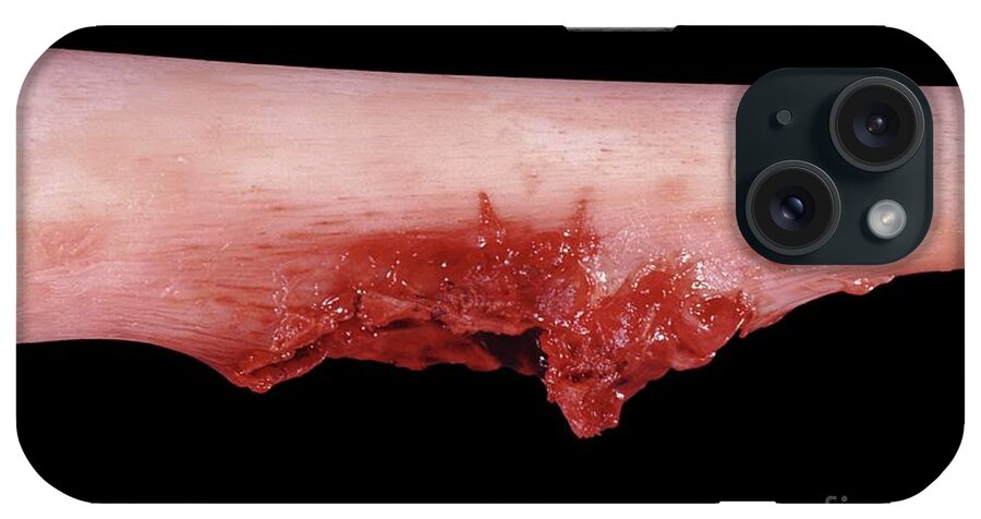 Bone iPhone Case featuring the photograph Osteosarcoma Of The Thigh Bone #2 by Jose Calvo / Science Photo Library