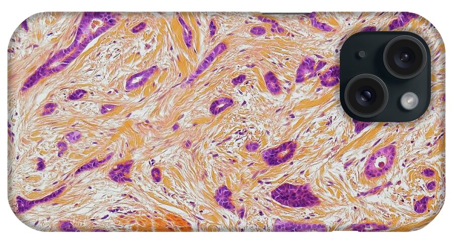 Breast Cancer iPhone Case featuring the photograph Breast Cancer #28 by Steve Gschmeissner/science Photo Library
