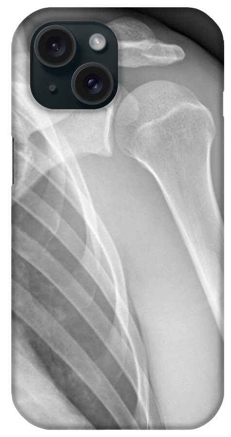 Tendon iPhone Case featuring the photograph Normal Shoulder, X-ray #3 by Zephyr