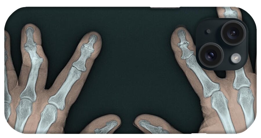 Abnormal iPhone Case featuring the photograph Psoriatic Arthritis, X-ray #3 by Steven Needell