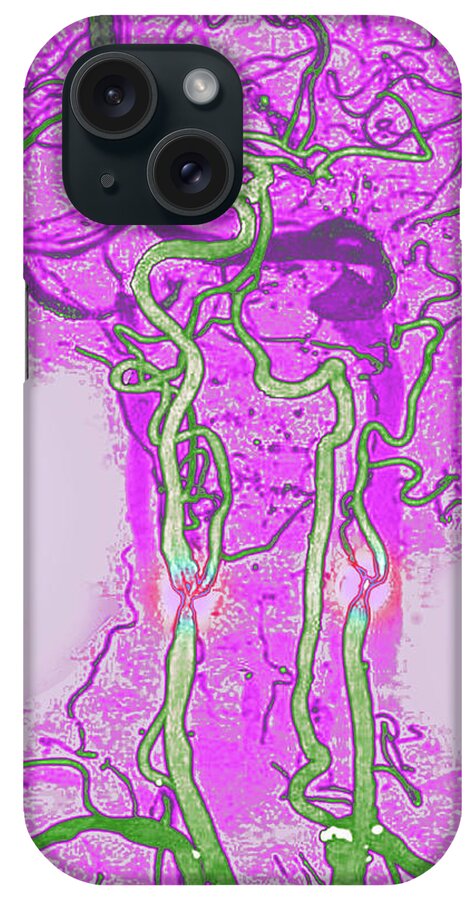 Artery iPhone Case featuring the photograph Carotid Stenosis by James Cavallini
