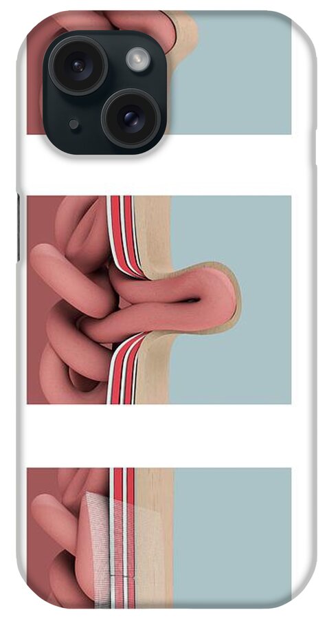 Abdominal iPhone Case featuring the photograph Hernia Anatomy And Repair by Mikkel Juul Jensen / Science Photo Library