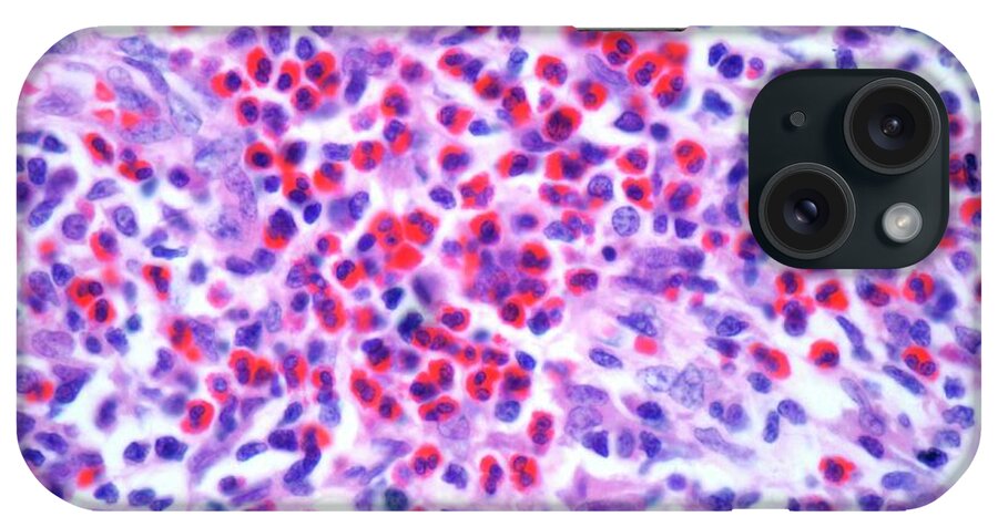 Anatomy iPhone Case featuring the digital art Hodgkins Lymphoma, Light Micrograph by Science Photo Library - Steve Gschmeissner