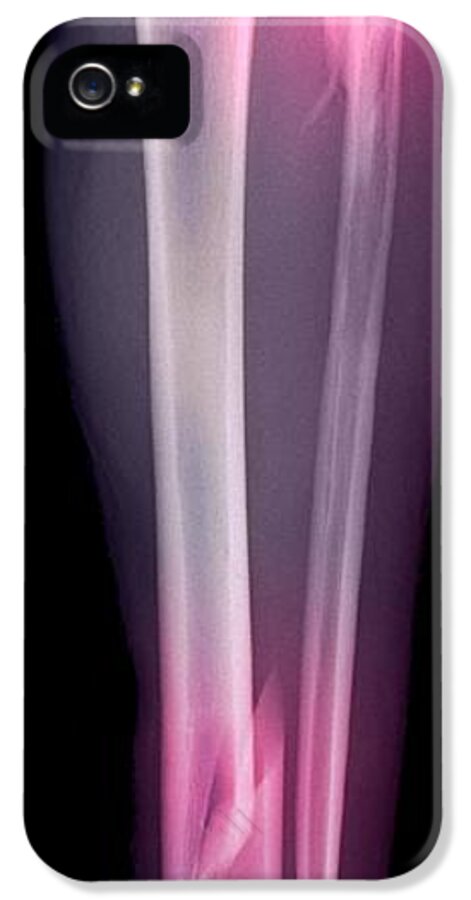 Coloured X-ray iPhone 5 Case featuring the photograph 'double Fracture To The Leg, X-ray' #1 by Du Cane Medical Imaging Ltd