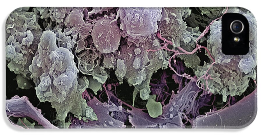 Medicine iPhone 5 Case featuring the photograph Breast Cancer Cells, Sem #20 by Steve Gschmeissner