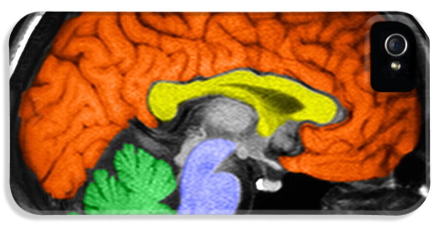 Medical iPhone 5 Case featuring the photograph Human Brain #10 by Ted Kinsman