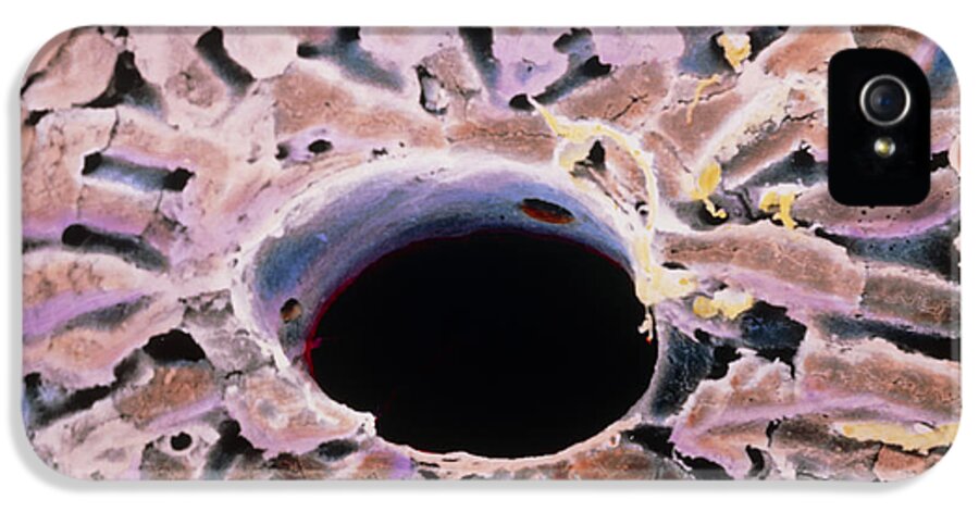 Liver Anatomy iPhone 5 Case featuring the photograph False-colour Sem Of A Lobule Of The Liver by Prof. P. Mottadept. Of Anatomyuniversity \la Sapienza\, Rome
