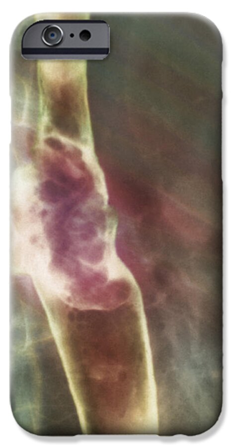 Verticalal iPhone 6 Case featuring the photograph Oesophagus Cancer, X-ray #1 by Cnri