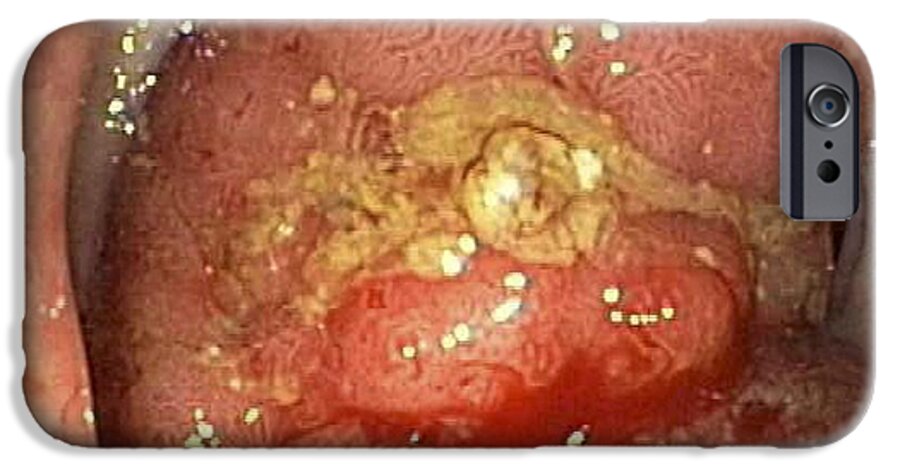 Adenoma iPhone 6s Case featuring the photograph Colon Adenoma by Gastrolab