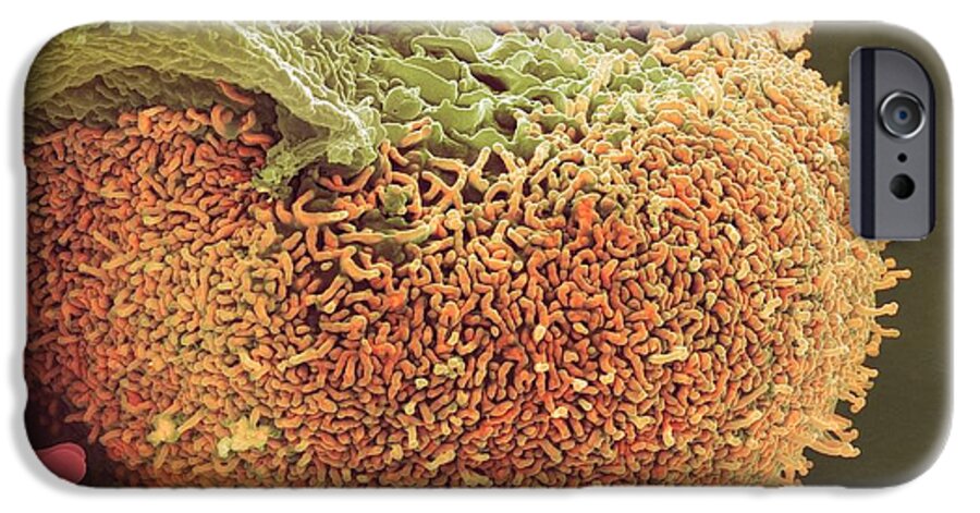Abnormal iPhone 6s Case featuring the photograph Urine Infection, Sem #1 by Steve Gschmeissner