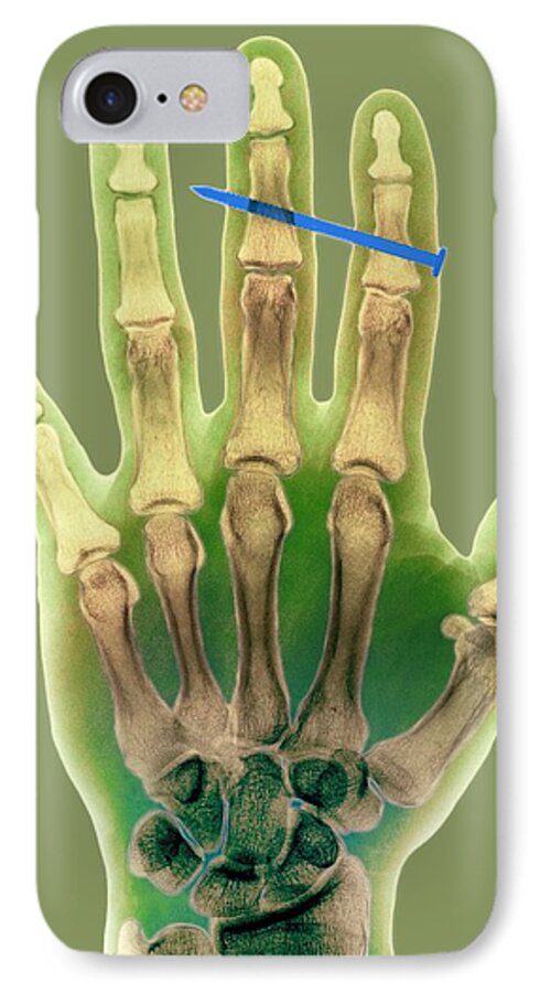 Nail iPhone 7 Case featuring the photograph Nail In Fingers, X-ray #1 by Kaj R. Svensson