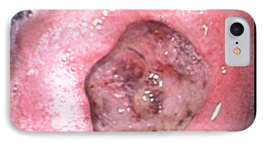 Gastric Ulcer iPhone 7 Case featuring the photograph Stomach Ulcer #2 by David M. Martin, Md