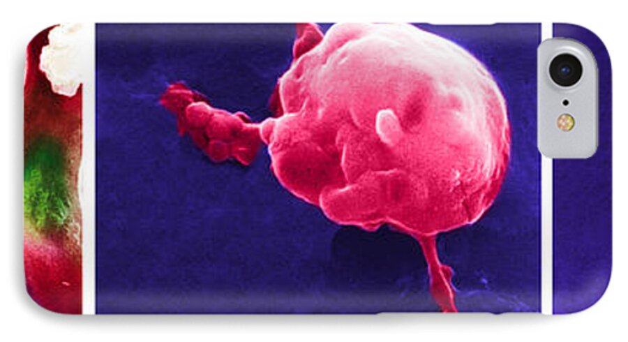 Scanning Electron Micrograph iPhone 7 Case featuring the photograph Cancer Cell Death Sequence, Sem #3 by Science Source