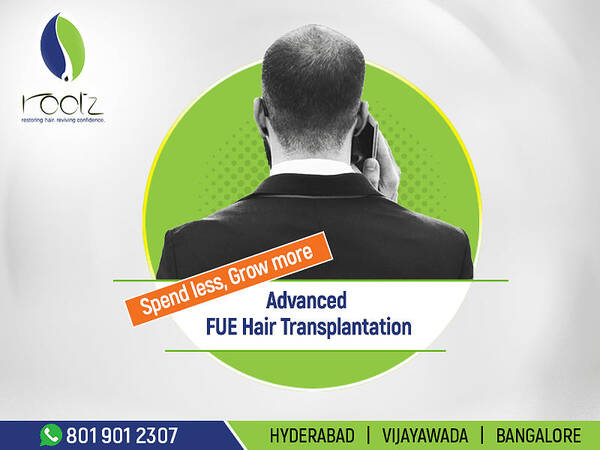 FUE hair transplant in bangalore,hyderabad and vijayawada Poster by Rootz  Hair - Fine Art America