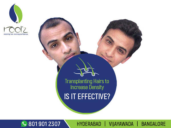 Hair Transplant In Hyderabad Poster by Rootz Hair - Fine Art America