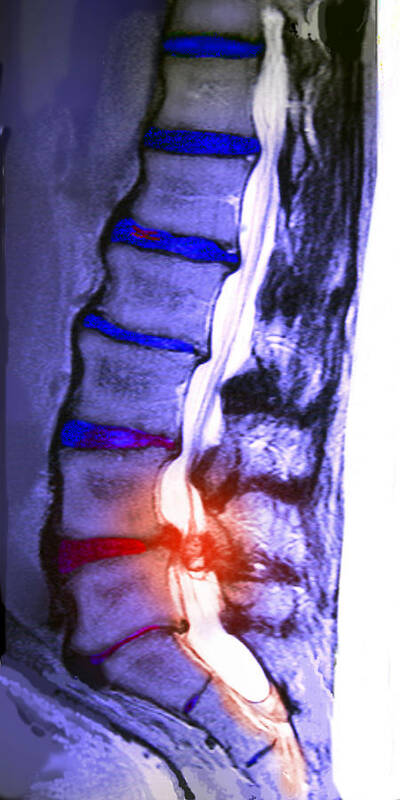 Aging Poster featuring the photograph Arthritic Spine by Chris Bjornberg