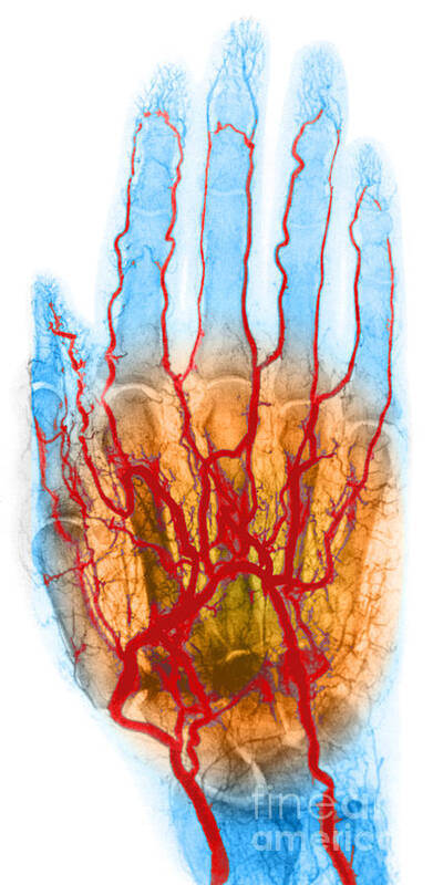 Angiogram Poster featuring the photograph Hand Arteriogram #3 by Science Source