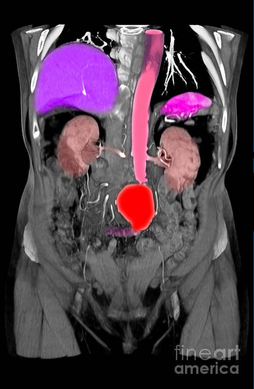 Ct Scan Poster featuring the photograph Ct Scan Of Abdominal Aortic Aneurysm #7 by Scott Camazine