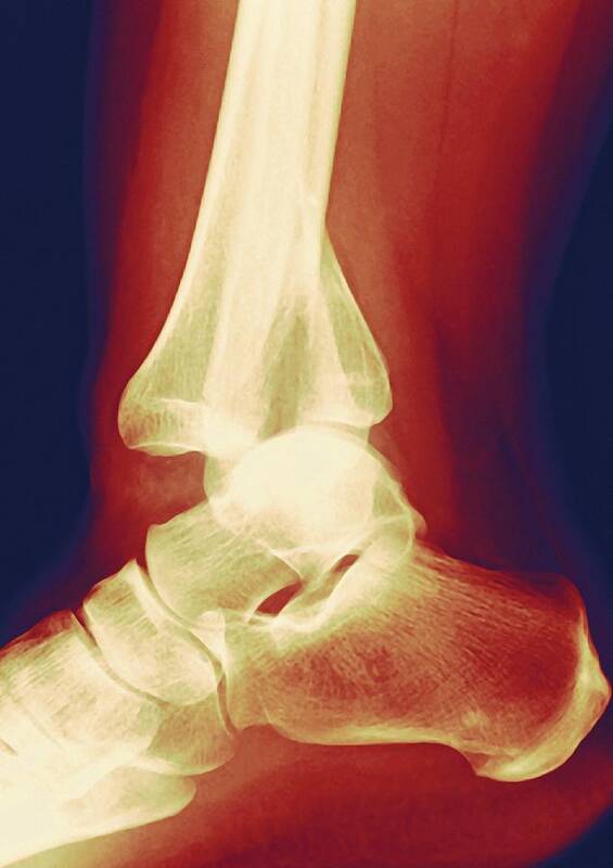 Joint Poster featuring the photograph Fractured Ankle, X-ray #1 by Miriam Maslo