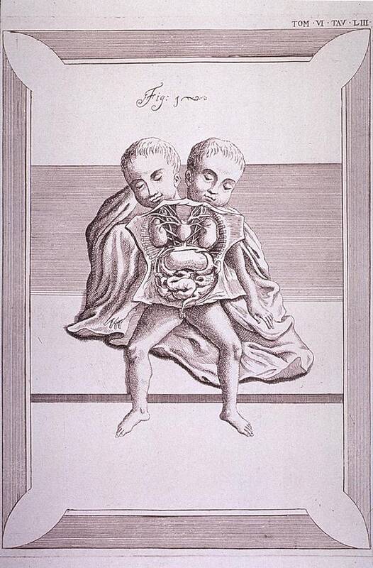 History Poster featuring the photograph Conjoined Twins With Common Torso by Everett