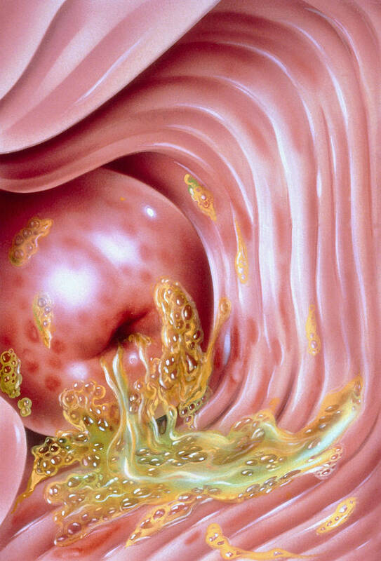 Trichomonas Vaginalis Poster featuring the photograph Illustration Of Trichomonas Of The Cervix by John Bavosi