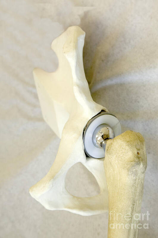 Artificial Hip Joint Poster featuring the photograph Hip Replacement by Inga Spence