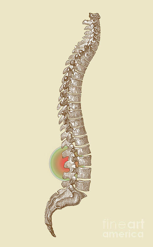 Ache Poster featuring the photograph Lower Back Pain #1 by Science Source