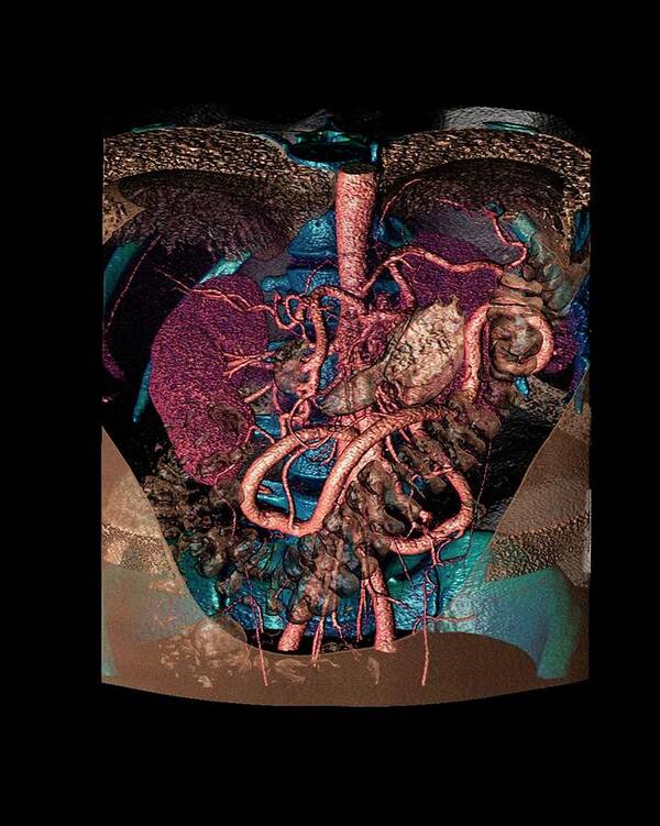 Mesenteric Artery Poster featuring the photograph Distended Mesenteric Artery by Anders Persson, Cmiv