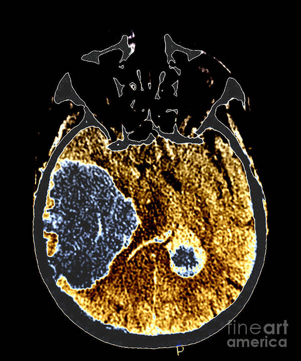 Ct Head Poster featuring the photograph Massive Intracranial Hemorrhage, Ct Scan by Living Art Enterprises