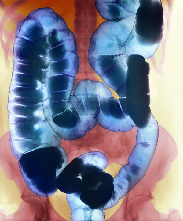 Colon Poster featuring the photograph Healthy Large Intestine, Barium X-ray #2 by 
