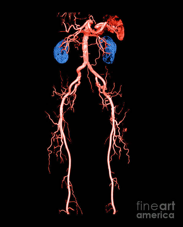 Abdominal Aorta Poster featuring the photograph Ct Angiogram Of Abdomen And Legs #3 by Medical Body Scans