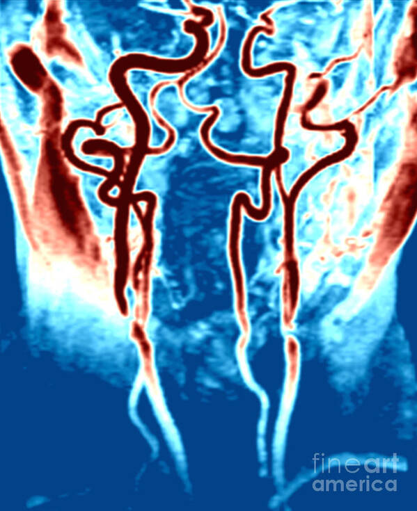 Mra Poster featuring the photograph Arteries In The Upper Chest, Neck by Medical Body Scans