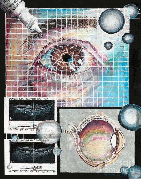 Eye Poster featuring the painting Macular Hole Repair by Merana Cadorette