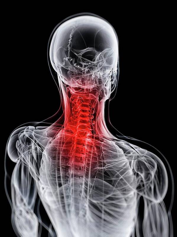 Artwork Poster featuring the photograph Neck Pain #2 by Sciepro/science Photo Library