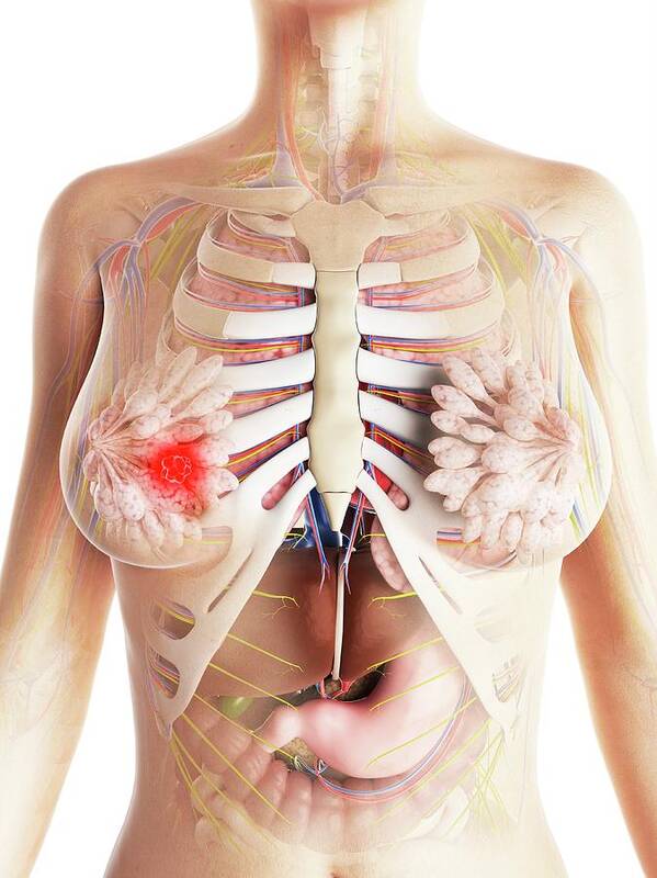 Unhealthy Poster featuring the photograph Breast Cancer #21 by Sciepro/science Photo Library