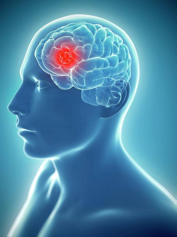 Unhealthy Poster featuring the photograph Brain Cancer #6 by Sciepro/science Photo Library