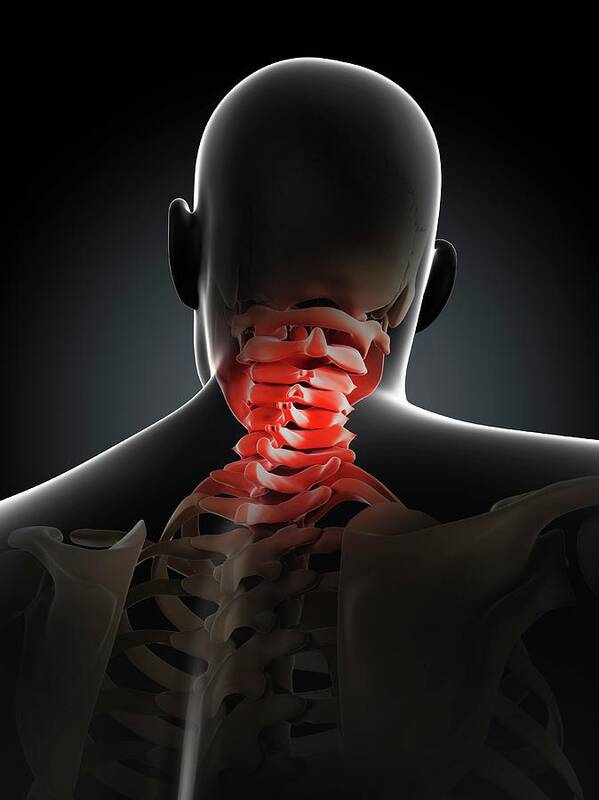 Unhealthy Poster featuring the photograph Neck Pain #9 by Sciepro/science Photo Library