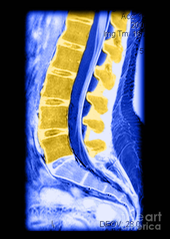Anatomy Poster featuring the photograph Normal Lumbar Spine #1 by Medical Body Scans