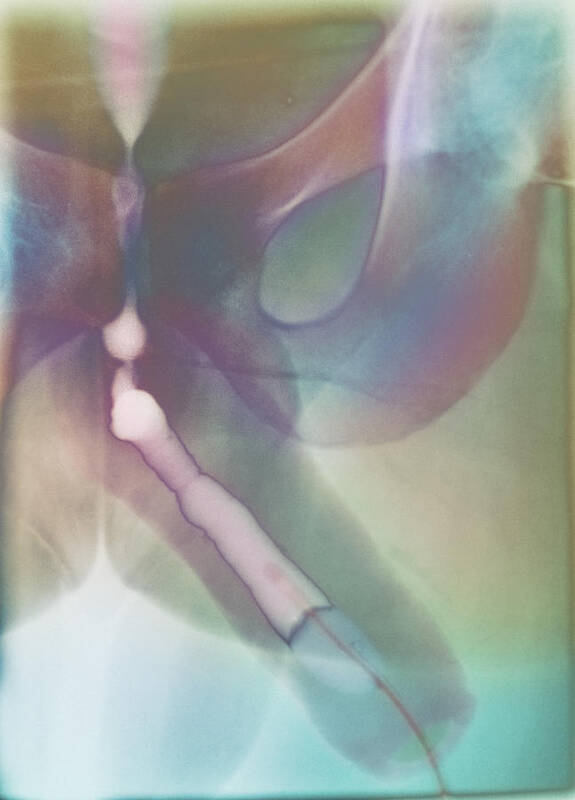 Infection Poster featuring the photograph Urethritis, X-ray #1 by 