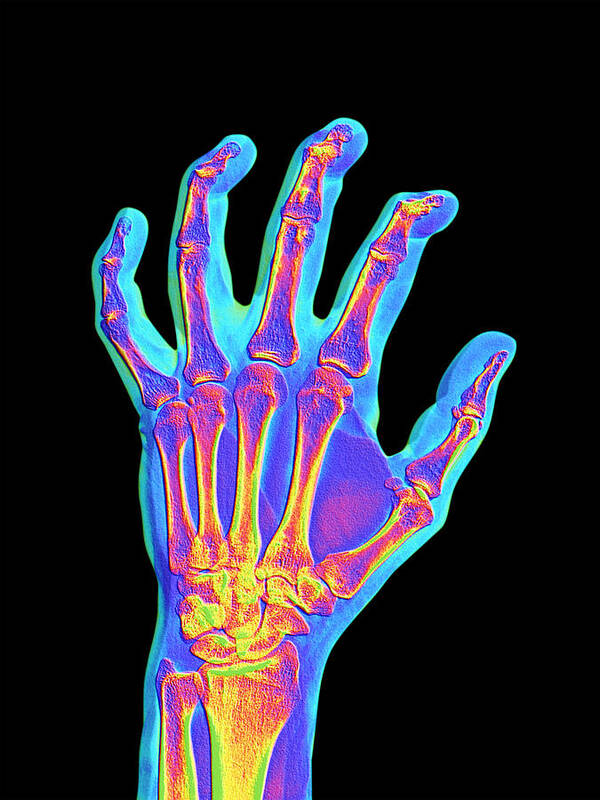 Osteoarthritis Poster featuring the photograph Arthritic Hand, X-ray #2 by Pasieka