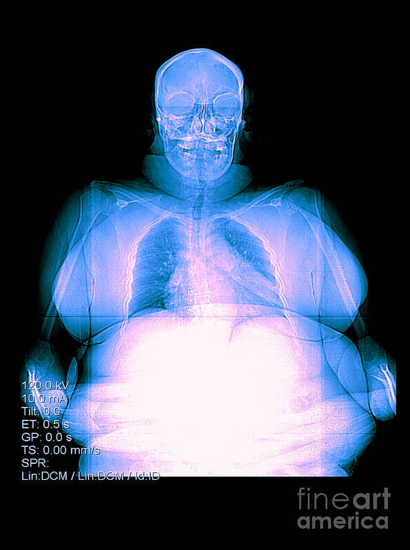 Anatomy Poster featuring the photograph Digital X-ray Of Obesity #2 by Medical Body Scans