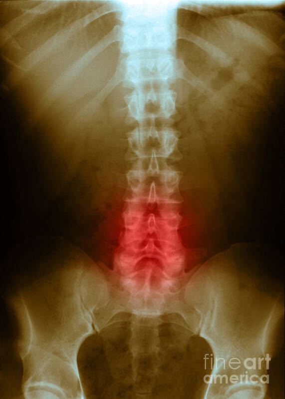 X Ray Poster featuring the photograph Compression In Lumbar Vertebrae #1 by Science Source