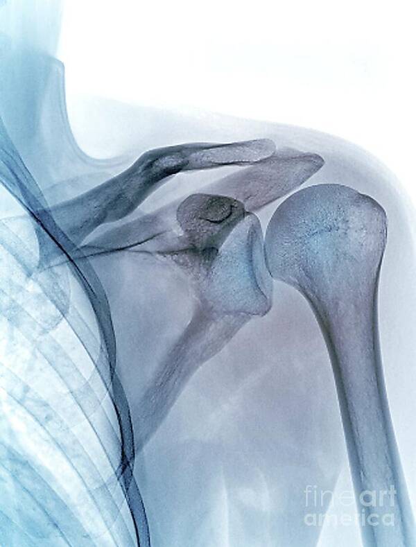 Joint Poster featuring the photograph Shoulder Joint #1 by Zephyr/science Photo Library