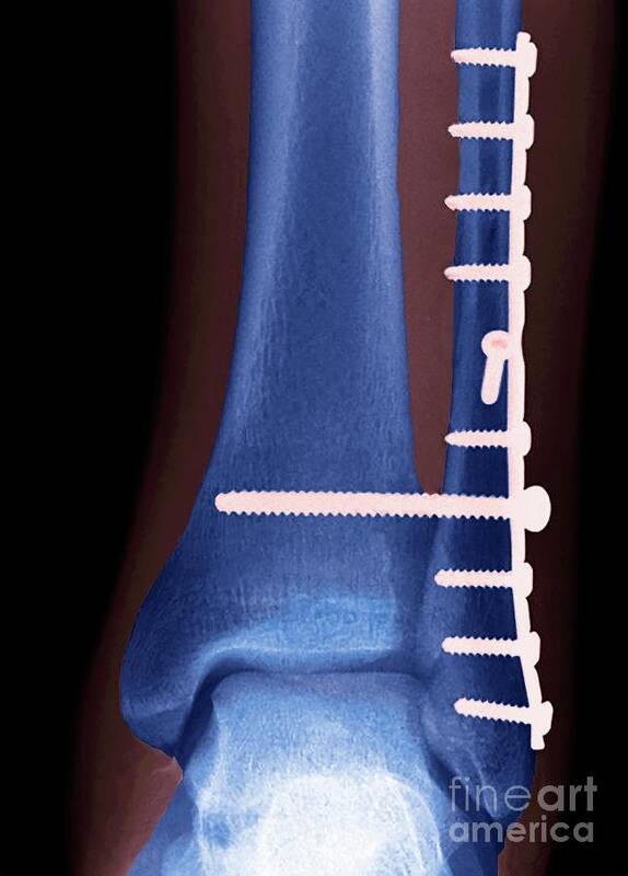 Ankle Poster featuring the photograph Ankle Fracture by Steve Gschmeissner/science Photo Library