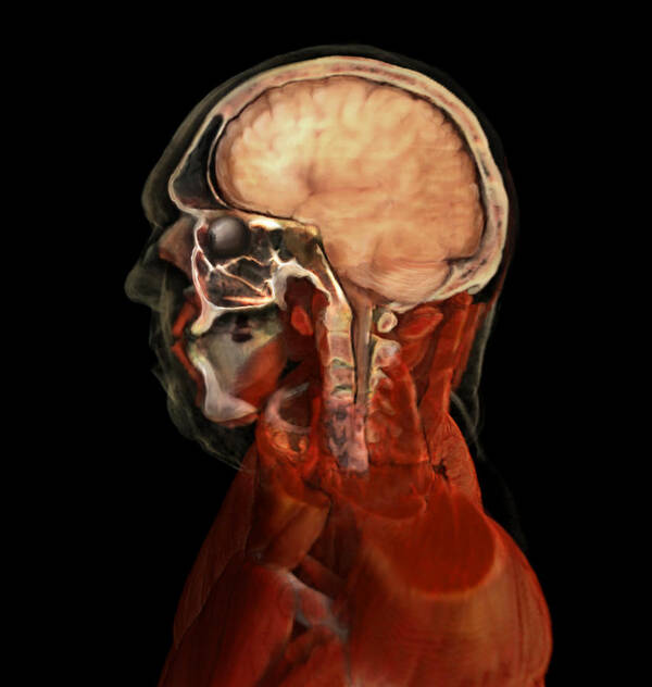 3d Visualization Poster featuring the photograph Brain And Nasal Cavity, Male Head by Anatomical Travelogue