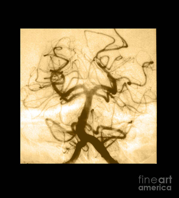 Abnormal Cerebral Angiogram Poster featuring the photograph Angiogram Of Embolus In Cerebral Artery #1 by Medical Body Scans