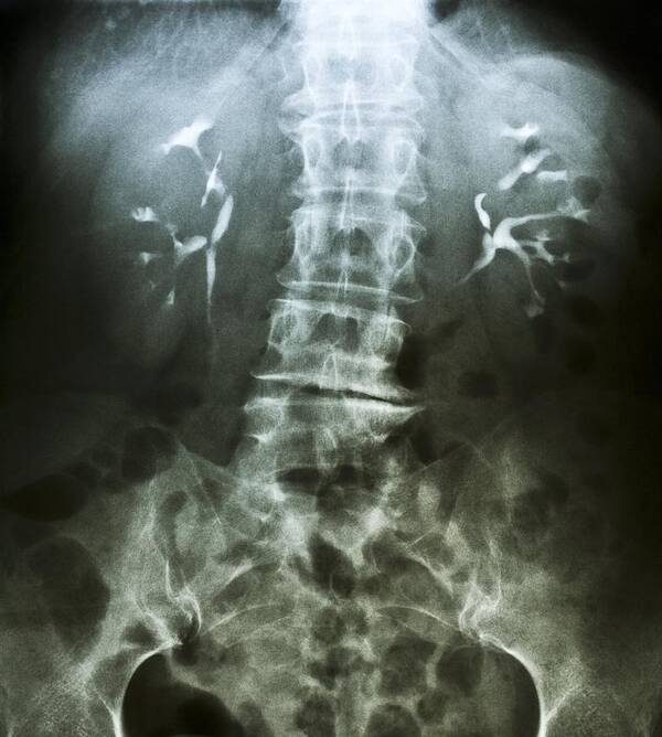 Abdominal Poster featuring the photograph False-col X-ray Of Lumbar Spine Of Woman #1 by Pasieka
