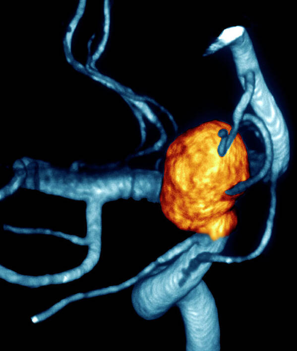 Artery Poster featuring the photograph Carotid Aneurysm #4 by Zephyr/science Photo Library