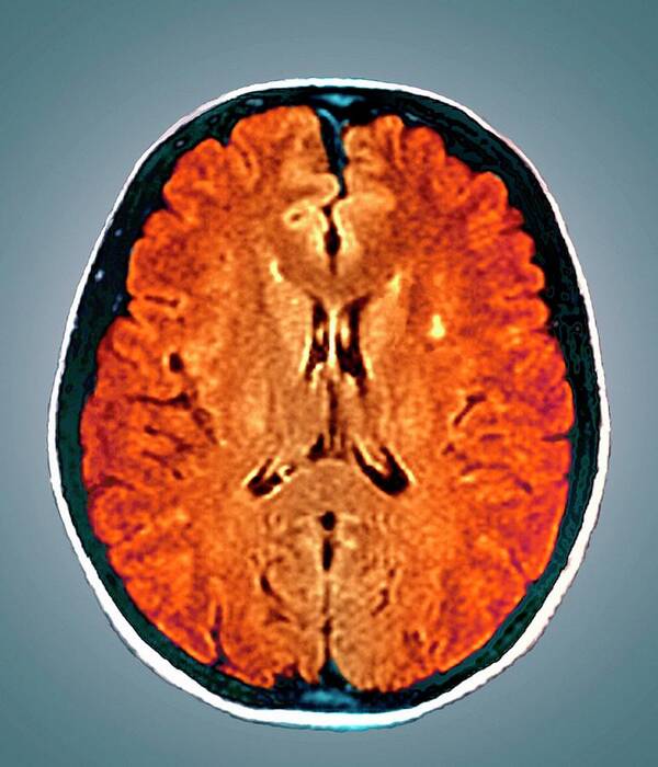 Magnetic Resonance Imaging Poster featuring the photograph Multiple Sclerosis #7 by Zephyr/science Photo Library