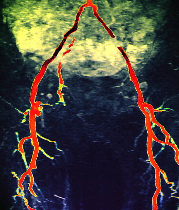 Prosthesis Poster featuring the photograph Arterial Stent by Zephyr/science Photo Library